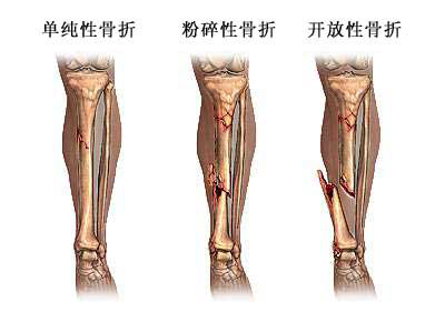 骨折修复术-骨折分类、手术方法、手术过程和手术预后（图片）