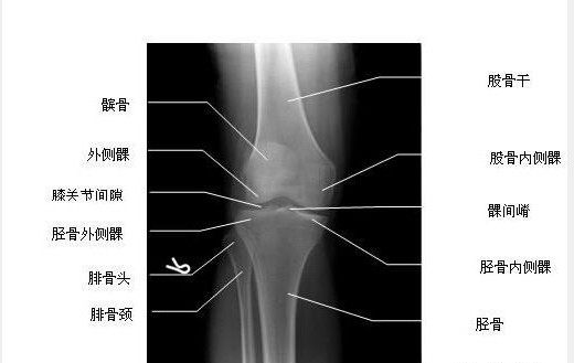 膝关节正位-X线片-解剖图片