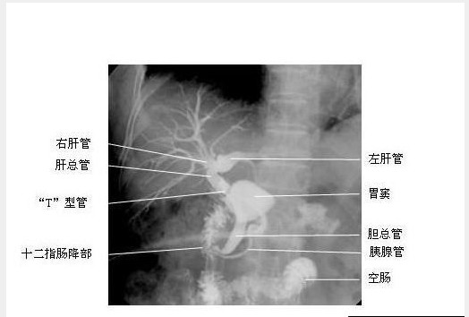 胆道造影-X线片-<font color="red">解剖图片</font>