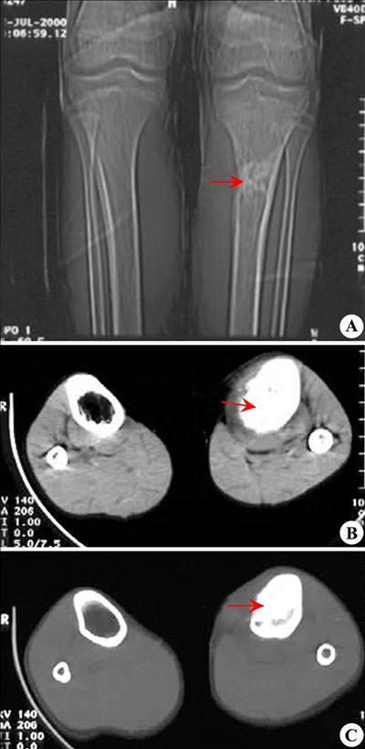 左胫骨上端<font color="red">骨肉瘤</font>（图）