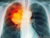 AJRCC：早期肺癌标志物HIP1与肺癌患者预后有关