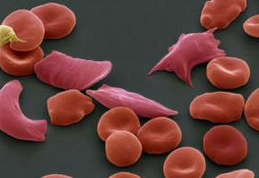 Lancet：羟基尿素可有效维持镰状细胞贫血儿童的TCD<font color="red">血流速度</font>