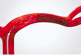 Lancet Haematology：<font color="red">静脉血栓</font>与心力衰竭之间的关系——荟萃分析、系统综述