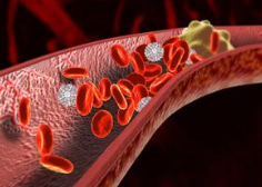 NEJM：普拉格雷对镰状细胞性贫血患者血管阻塞性危象无效