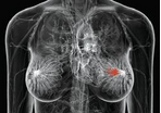 Lancet：<font color="red">阿</font><font color="red">那曲</font><font color="red">唑</font> vs 他莫昔芬治疗对导管原位癌切除的绝经后女性生活质量的影响