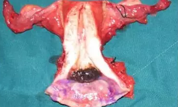 宫颈黑色素瘤一例