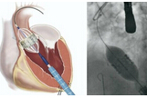 NEJM： 经导管主动脉瓣膜置换术在临床上的应用效果
