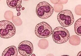 Lancet Haematology：阿仑单抗治疗T细胞大颗粒淋巴细胞性白血病患者可减少毒性