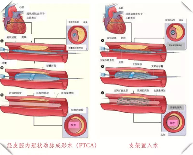 心脏支架的历史