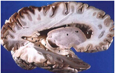 Eur Neurol：脑室周围白质高信号可预测其边缘梗死