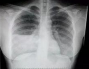 JAMA： 恶性胸腔积液患者的疼痛和胸膜固定术疗效和胸管大小有关