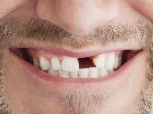 人的一生会失去多少牙齿？
