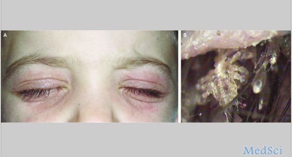 NEJM：眼睑部位出现持续性红斑和瘙痒病例报道