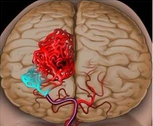 J Neurosurg：抗栓治疗增加了过去<font color="red">15</font>年非动脉瘤性蛛网膜下腔出血的发生？