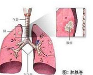 研究发现治疗周围型小病灶肺腺癌有效方法