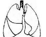 JCO：中国学者提出三位一体亚肺叶切除术精确指征
