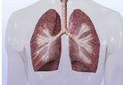 Eur J Epidemiol：慢性阻塞性肺疾病患者卒中发生增加