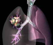 特异免疫疗法：为肺癌治疗开扇窗