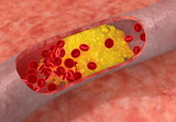 JACC：血管钙化会加速相关心血管<font color="red">事件</font>进展吗？