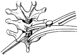 脊柱侧凸畸形Luque手术