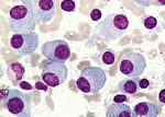 Lancet：<font color="red">Daratumumab</font>治疗难治性多发性骨髓瘤效果显著