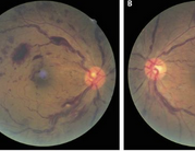 NEJM：巨球蛋白血症致视网膜病变-案例报道