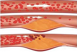 ACS <font color="red">Nano</font>：神奇研究用“磁铁”指引纳米颗粒 对抗动脉硬化！