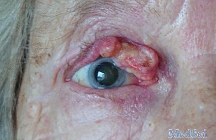 BMJ：眼睑局部浸润性鳞状细胞癌-案例报道