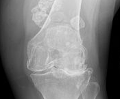 BMJ：不典型双侧膝关节骨关节炎-案例报道