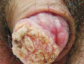 NEJM：一例阴茎鳞状细胞癌，HPV也同样对男性致癌