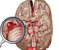 JAMA Neurol：警惕以“短暂性脑<font color="red">缺血</font>发作”为<font color="red">症状</font>的“脑出血”