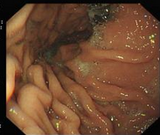 Gastroenterology：辛伐他汀在降低肝硬化食管静脉曲张破裂出血患者中的作用