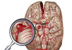 J <font color="red">Stroke</font> Cerebrovasc Dis：脑出血后早期再入院较常见