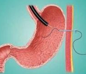 Gastroenterology：强化肠内营养并不能改善重型酒精性肝炎患者生存期