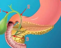 Gastroenterology：吲哚美辛能否预防ERCP后胰腺炎的发生？