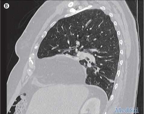 Lancet：呼吸急促、喉咙痛一周病例报道（Morgagni疝）