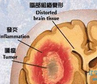 “全球脑胶质瘤<font color="red">适应性</font><font color="red">临床</font>创新<font color="red">试验</font>体系”中国项目启动