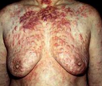 Lancet infect dis：皮肤利什曼病的全球负担（2013世界疾病负担研究）