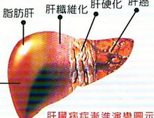 Gastroenterology：Elafibranor治疗非酒精性<font color="red">脂肪性肝炎</font>