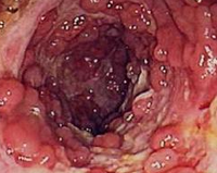Am J Gastroenterol：激素难治性重症溃疡性结肠炎：环孢素 vs 英夫利昔单抗（IFX）