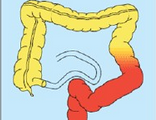 Am J <font color="red">Gastroenterol</font>：吸烟对克罗恩疾病复发的影响