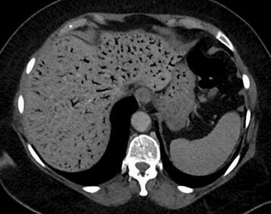 BMJ：肝门静脉积气——案例报道