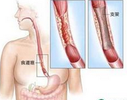 Am J Gastroenterol：食管动力障碍疾病的诊断：HRM vs CM