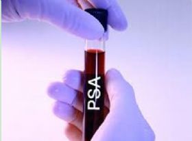 血清肿瘤标志物PSA检测助力前列腺癌有效<font color="red">管理</font>
