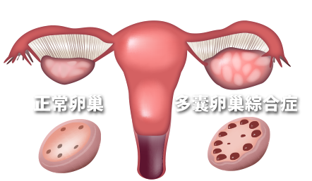 <font color="red">棕色</font>脂肪移植或可改善多囊卵巢综合征