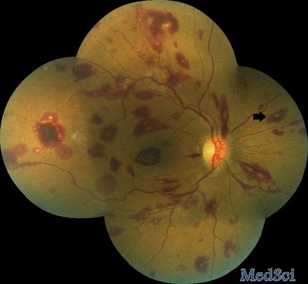 BMJ：一例再生障碍性贫血，双眼急性无痛性视力下降