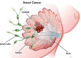 Eur J Cancer：免疫组化预测转移性乳腺癌接受大剂量化疗联合自体造血干细胞移植的生存率