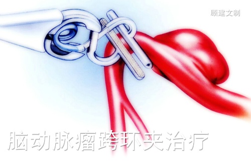 神奇的跨血管<font color="red">动脉瘤</font><font color="red">夹</font>