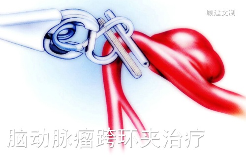 <font color="red">神奇</font>的跨血管动脉瘤夹