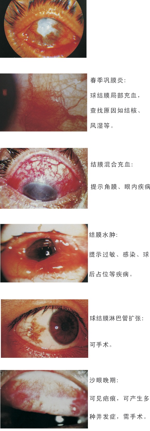 春季巩膜炎、结膜混合充血、结膜水肿、球结膜淋巴管扩张、沙眼晚期